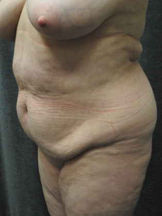 Abdominoplasty Case 7 - San Antonio - Before