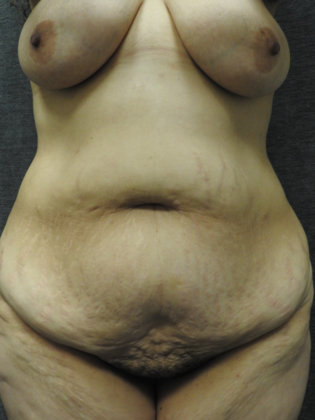 Abdominoplasty Case 6 - San Antonio - Before