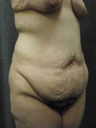 Post Bariatric Plastic Surgery: Case 4 - San Antonio - Before