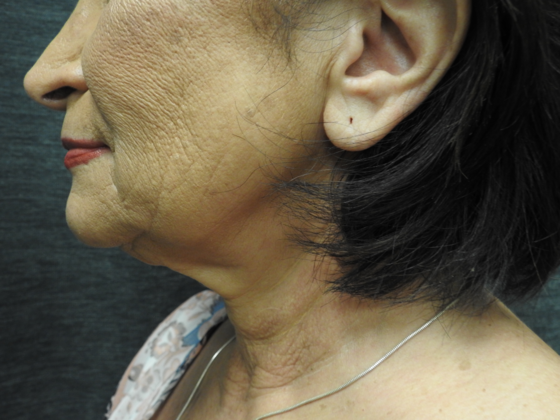 QuickLift Case 12 - San Antonio - Before