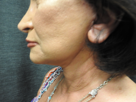 QuickLift Case 12 - San Antonio - After