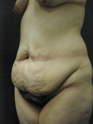 Abdominoplasty Case 9 - San Antonio - Before
