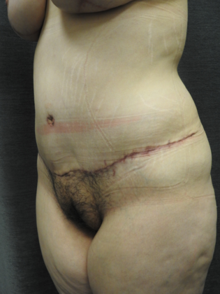 Abdominoplasty Case 9 - San Antonio - After