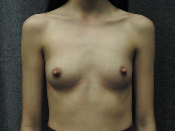 Ideal Implant Case 4 - San Antonio - Before