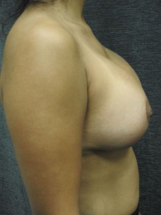 Ideal Implant: Case 5 - San Antonio - After