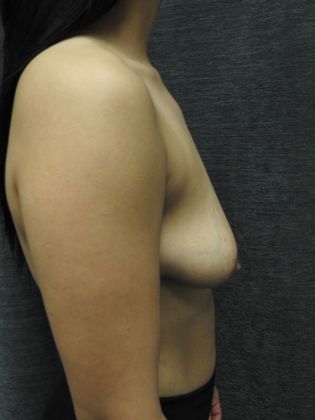 Ideal Implant: Case 5 - San Antonio - Before