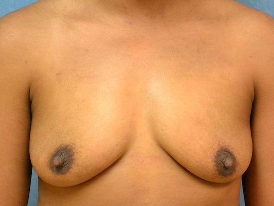 Breast Augmentation Case 1353- Fostoria, OH - Before