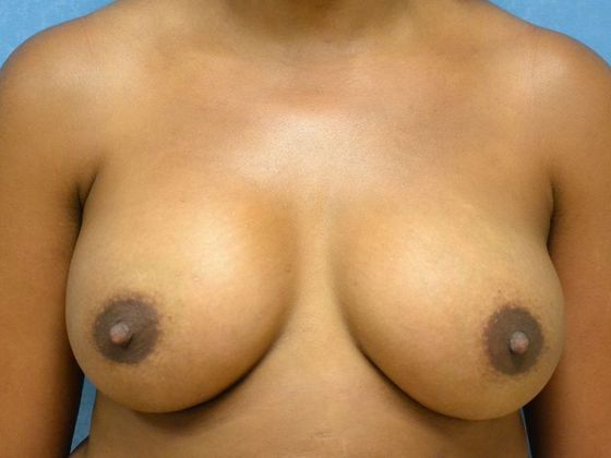 Breast Augmentation Case 1353- Fostoria, OH - After