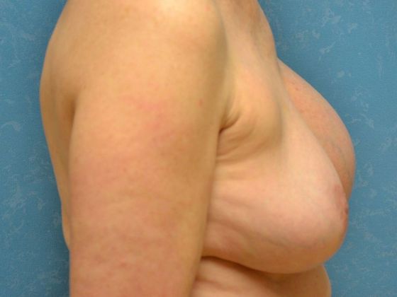 Breast Augmentation: Case 1357- Definace, OH - Before