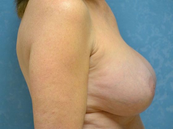 Breast Augmentation: Case 1357- Definace, OH - After