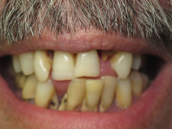 Teeth in a Day: Joseph - Before