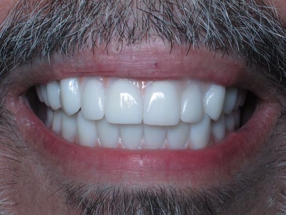 Teeth in a Day: Joseph - After