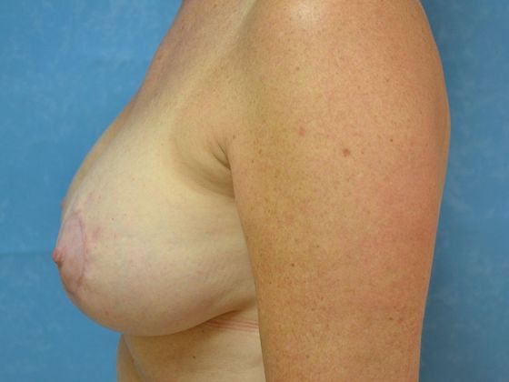 Breast Augmentation: Case 1360- Ida, MI - After