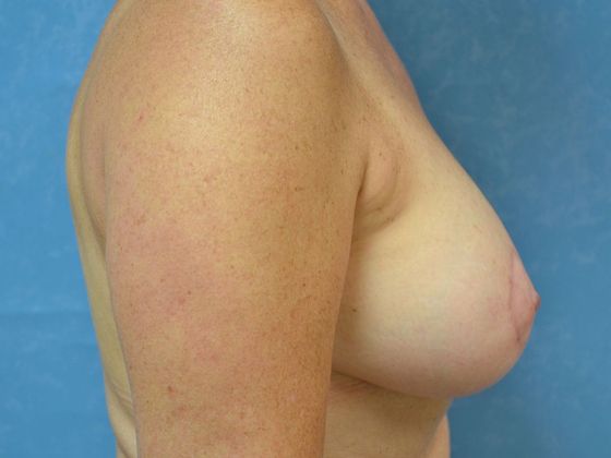 Breast Augmentation: Case 1360- Ida, MI - After