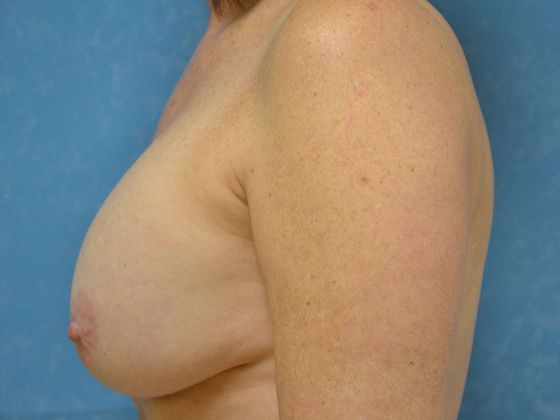 Breast Lift: Case 1440- Ida, MI - Before