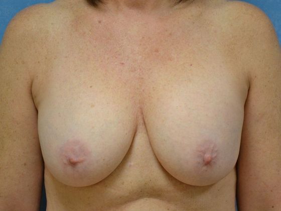 Breast Lift Case 1440- Ida, MI - Before