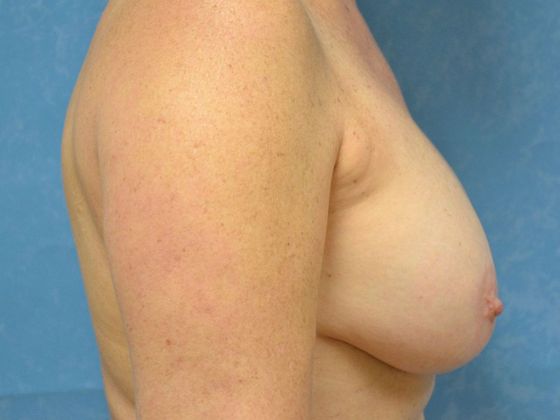 Breast Lift: Case 1440- Ida, MI - Before