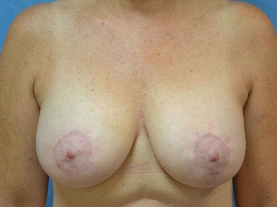 Breast Lift Case 1440- Ida, MI - After