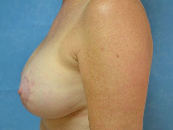 Breast Lift: Case 1440- Ida, MI - After