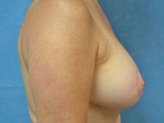 Breast Lift: Case 1440- Ida, MI - After