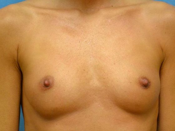 Breast Augmentation Case 1361- Findlay, OH - Before