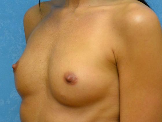 Breast Augmentation: Case 1361- Findlay, OH - Before