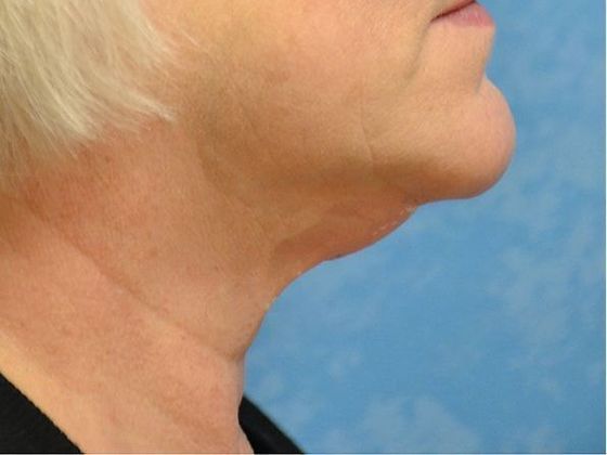 Kybella Case 1607- Port Clinton, OH - Before