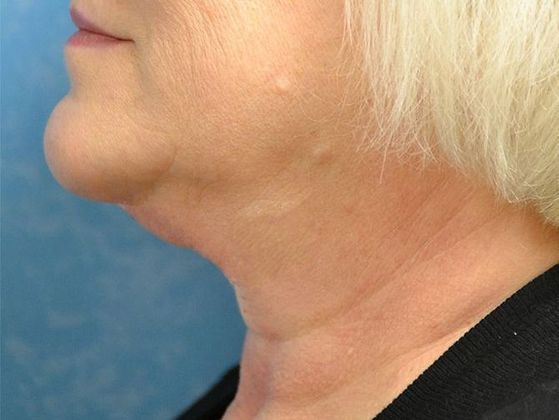 Kybella: Case 1607- Port Clinton, OH - Before
