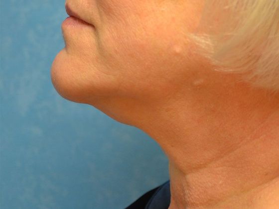 Kybella: Case 1607- Port Clinton, OH - After