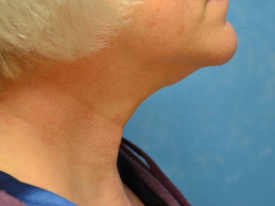 Kybella Case 1607- Port Clinton, OH - After