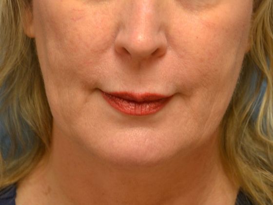 Botox® and Fillers JV 1247- Toledo, OH - Before