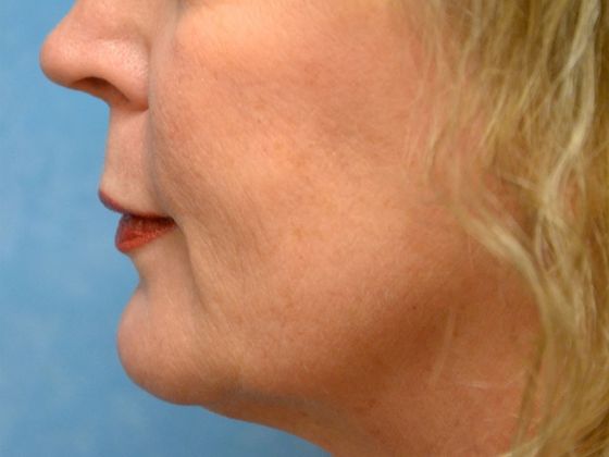 Botox® and Fillers: JV 1247- Toledo, OH - Before