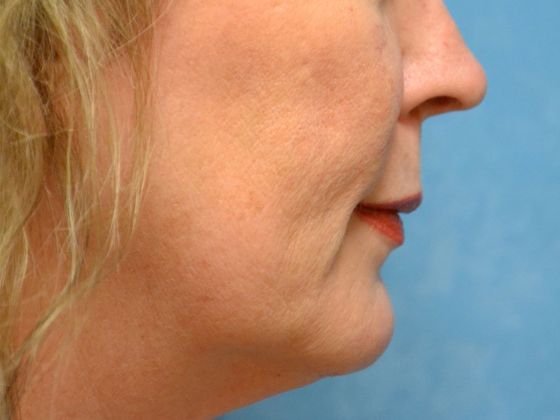 Botox® and Fillers: JV 1247- Toledo, OH - Before
