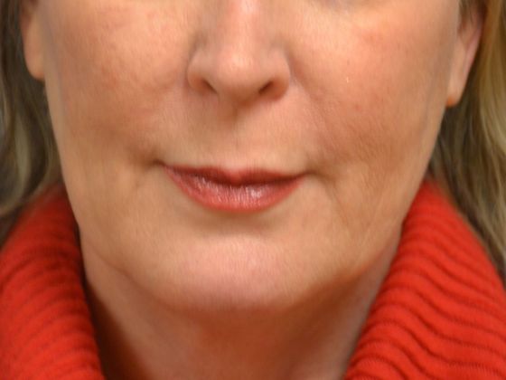 Botox® and Fillers JV 1247- Toledo, OH - After