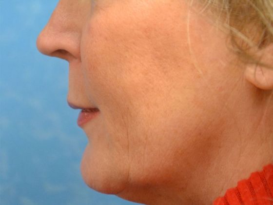 Botox® and Fillers: JV 1247- Toledo, OH - After