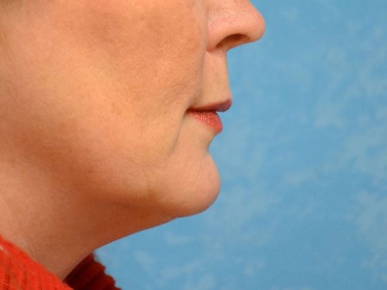 Botox® and Fillers: JV 1247- Toledo, OH - After