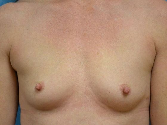 Breast Augmentation Case 1362- Mount Cory, OH - Before