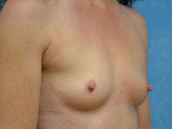Breast Augmentation: Case 1362- Mount Cory, OH - Before
