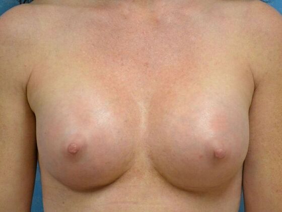 Breast Augmentation Case 1362- Mount Cory, OH - After