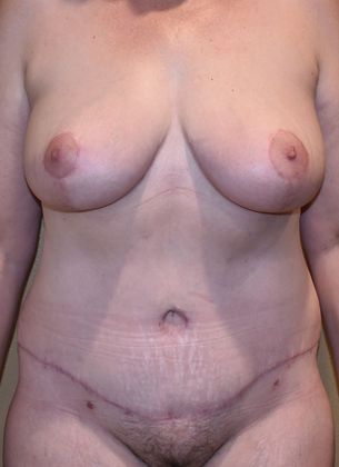 Mommy Makeover Case 113 - After