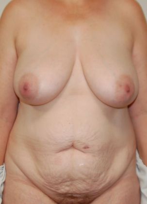 Mommy Makeover Case 113 - Before