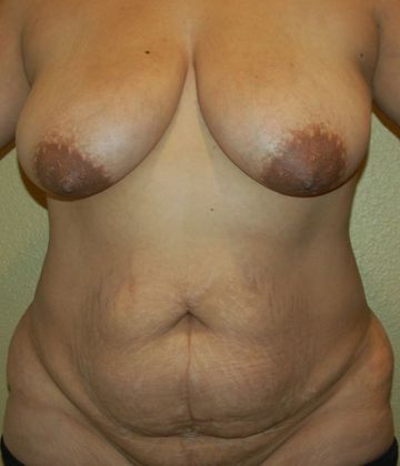 Mommy Makeover Case 114 - Before