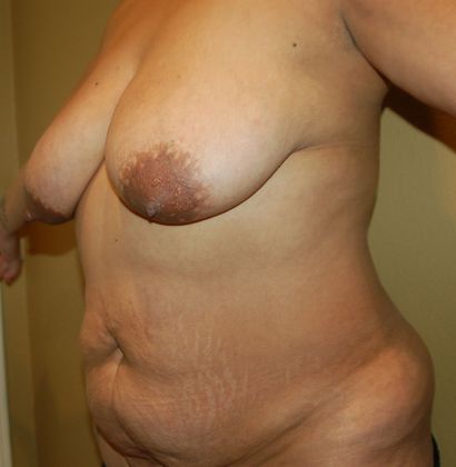 Mommy Makeover: Case 114 - Before