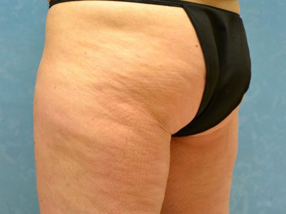 Coolsculpt: Case 1606- Sylvania, OH - Before