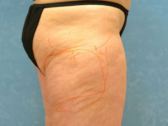 Coolsculpt: Case 1606- Sylvania, OH - Before