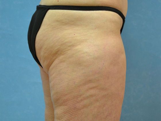 Coolsculpt: Case 1606- Sylvania, OH - After