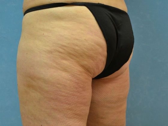 Coolsculpt: Case 1606- Sylvania, OH - After