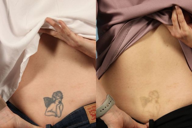 Pleasant Valley  Laser Tatoo Removal  Before and After Gallery