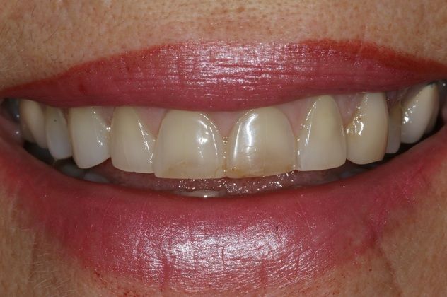 Full Mouth Rehabilitation Kim - Before