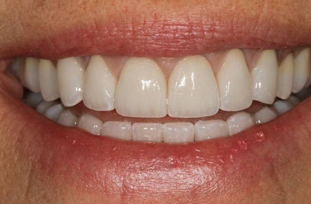 Full Mouth Rehabilitation Kim - After